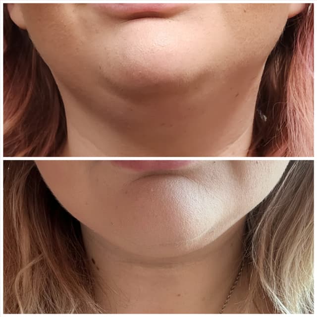 Youthful Chin at Curve Love, LLC in Greenfield, OH
