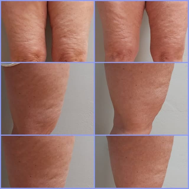 12 LipoSculpt Sessions at Curve Love, LLC in Greenfield, OH